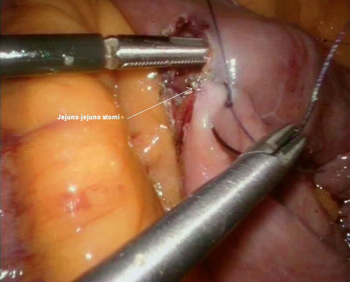 Bilde 4. Siste del av jejuno-jejunostomien syes laparoskopisk.